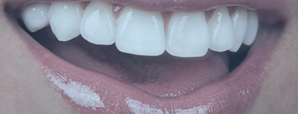 Já viu uma lente de contato dental? A Joy Care explica essa história…