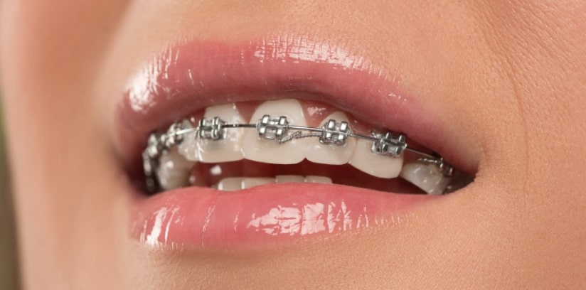 Uniodonto oferece plano carência zero com opção de ortodontia